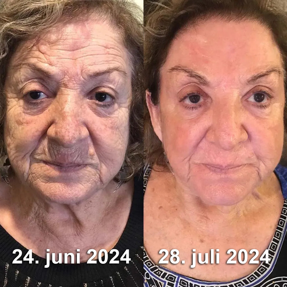 🍎💎Fremstillet og afsendt fra Danmark✅Furzero™ Botox Bi-Venom Rynkefjerningscreme – Sidste dags kampagne: Spar 70%